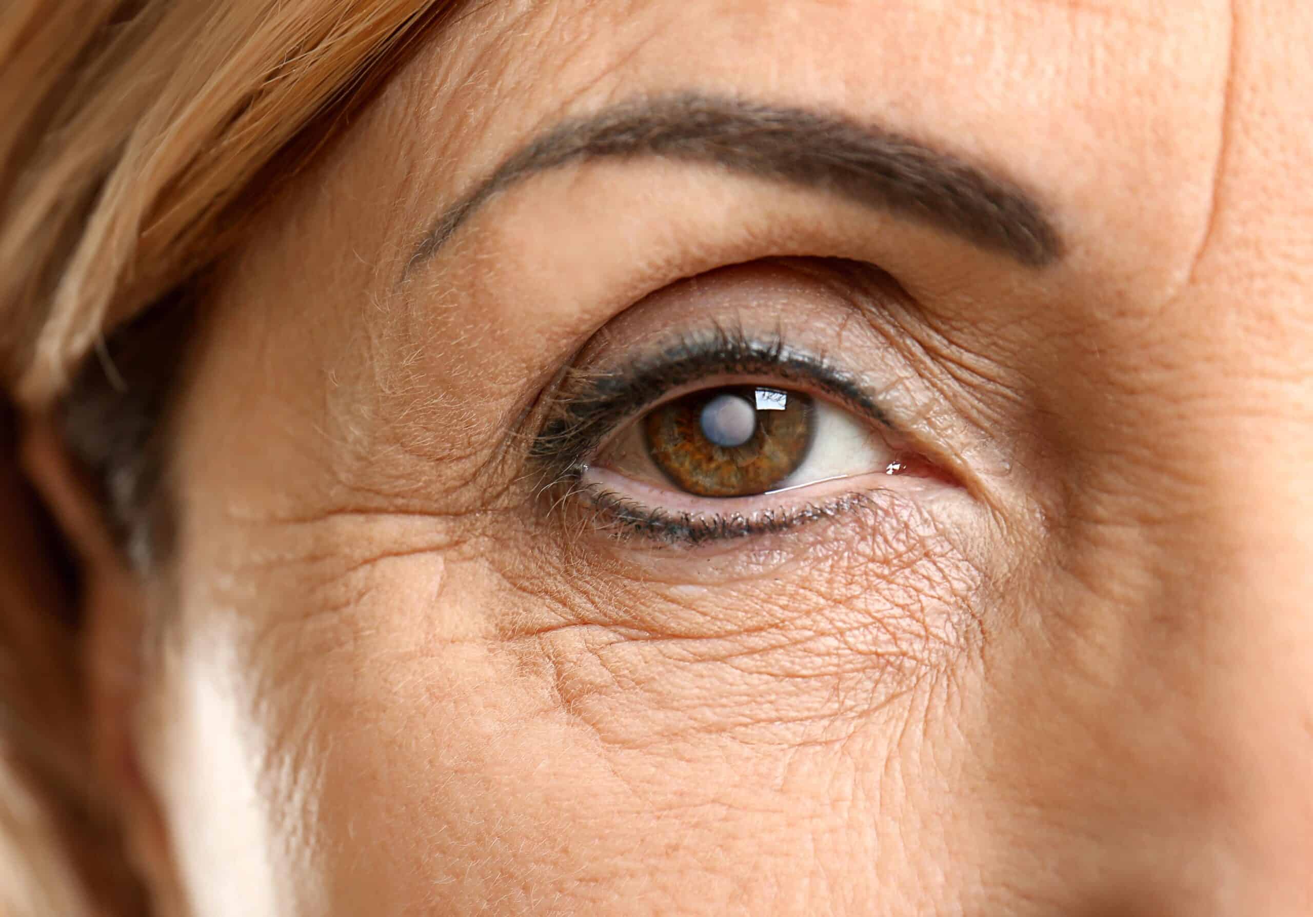 What causes a cataract?